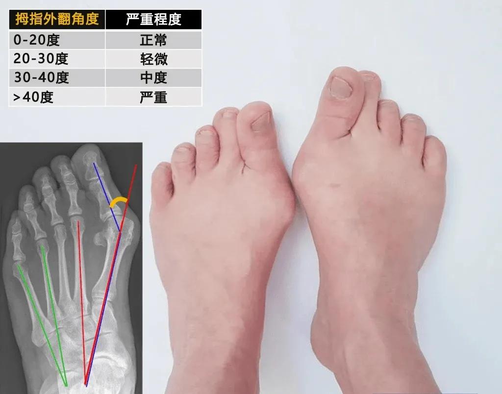 大脚趾侧面肿痛怎么缓解,大拇脚趾红肿疼痛怎么治疗