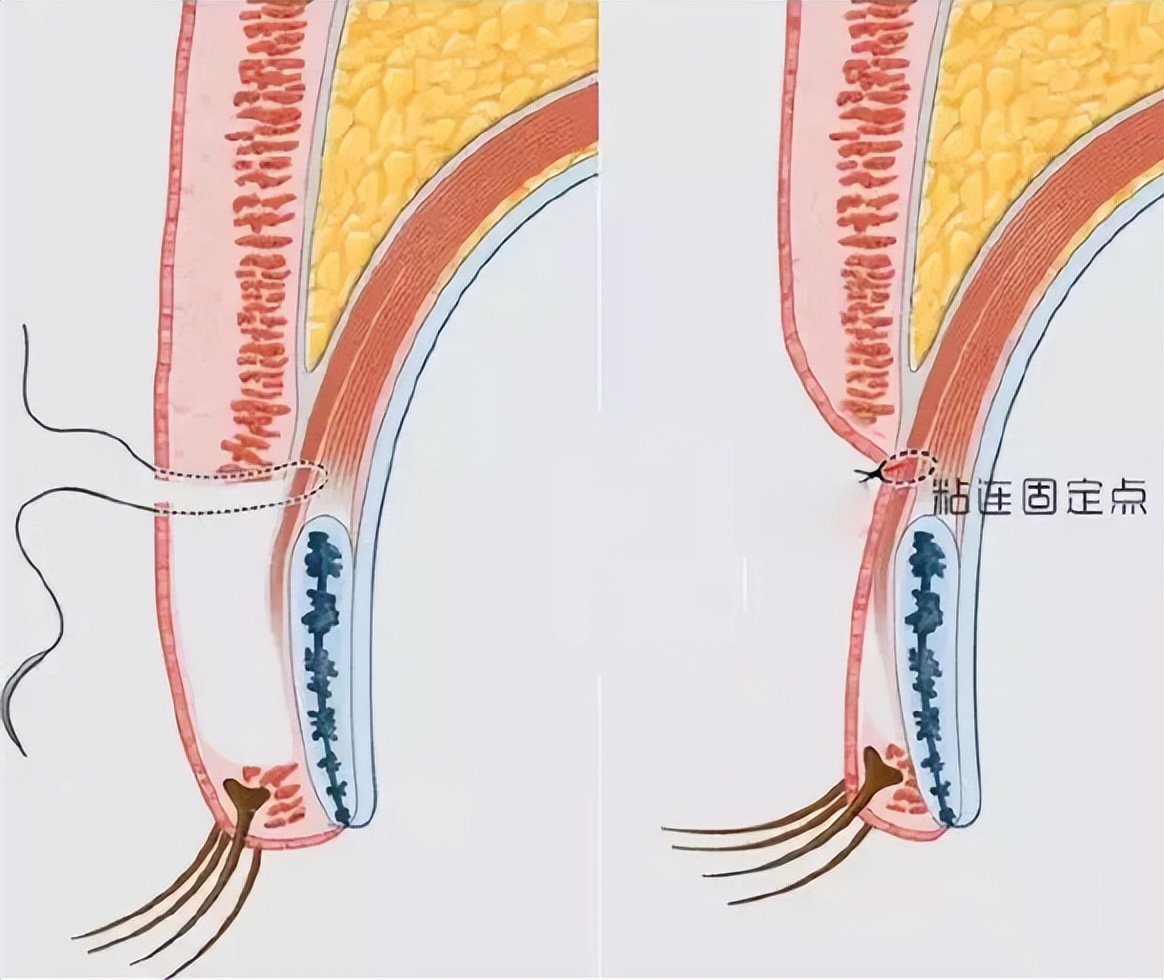 为什么双眼皮太宽睁不开,双眼皮为什么不建议全切