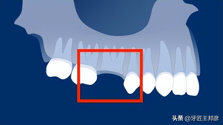 智齿牙根掉入间隙,智齿自己掉了牙根还在里面怎么办