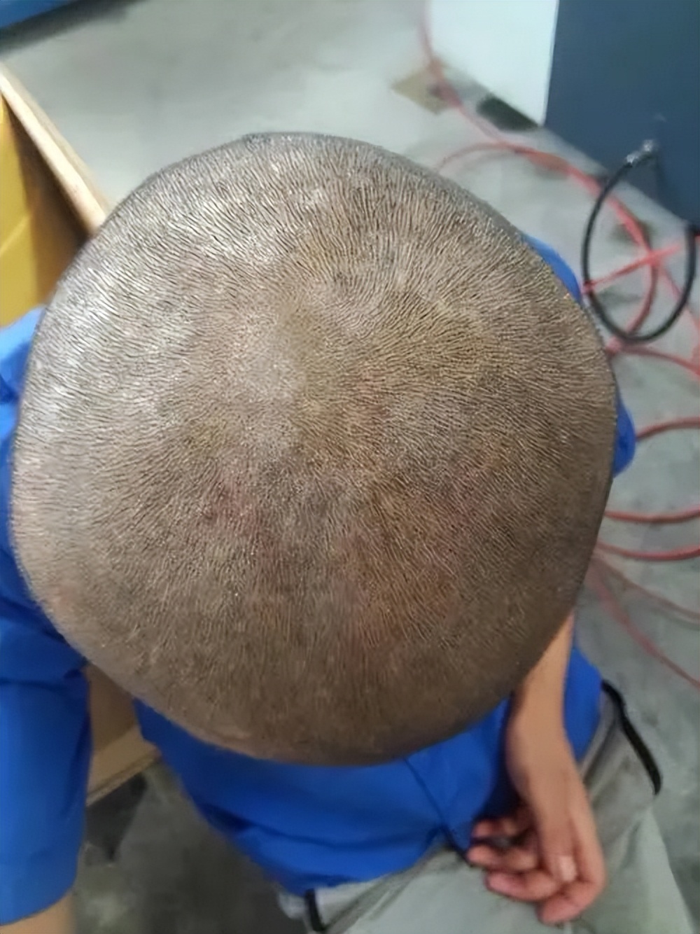 银屑病头皮屑症状中医,银屑病头屑增多是好转还是加重