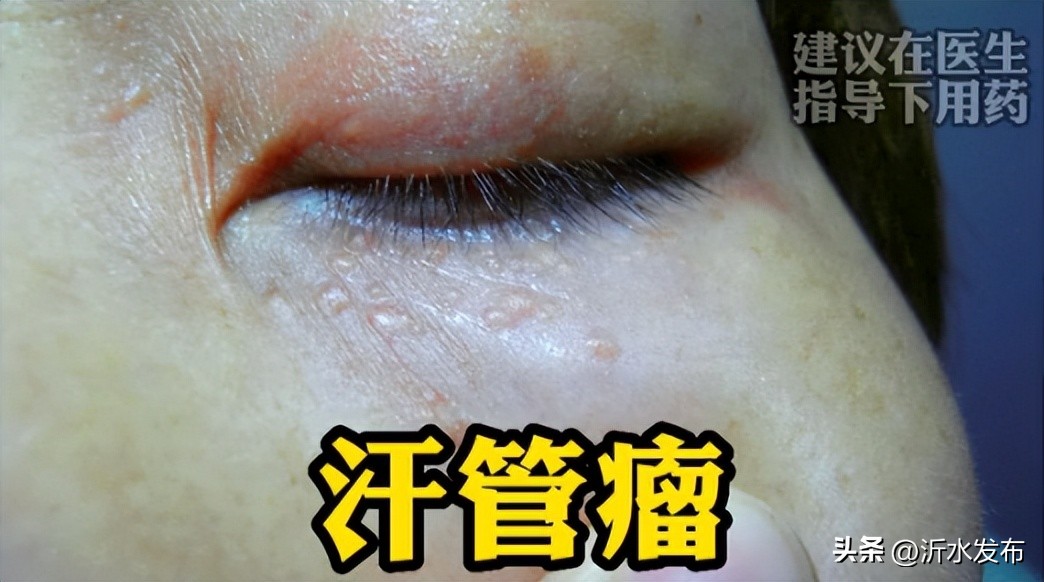 眼周长小小的疣,眼周长小丘疹是怎么回事