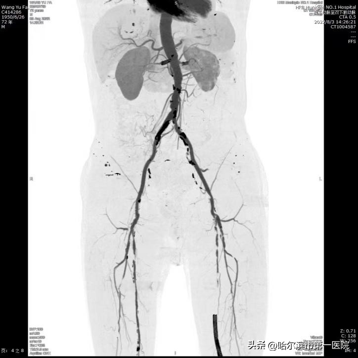 打通患者生命通道哈尔滨市第一医院血管外科应用动脉机械吸栓（Rotarex）新技术清除老人下肢动脉支架内血栓