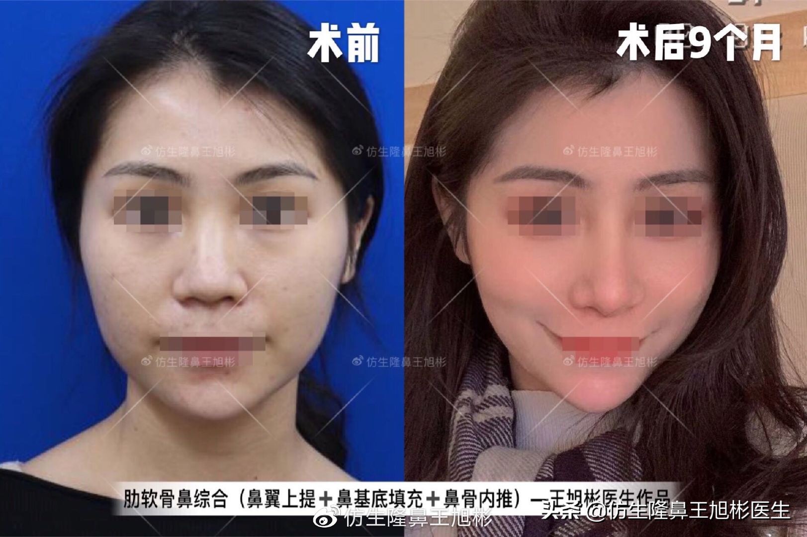 常见鼻部整形美容项目,整形鼻和自然鼻