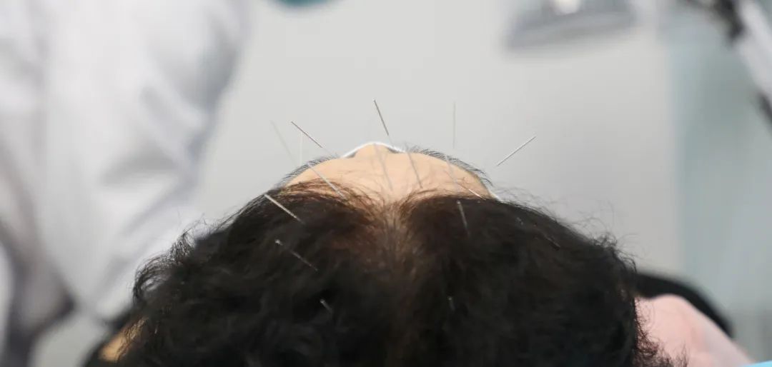 中医治疗视网膜色素变性,常州中医治疗视网膜色素变性