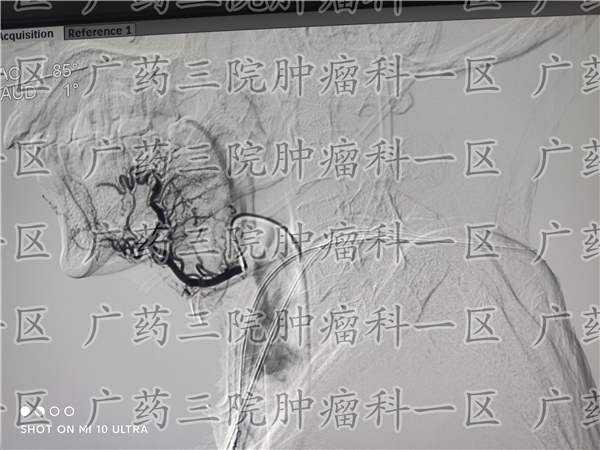 舌癌广州中医院,舌癌晚期舌头烂了一半怎么办