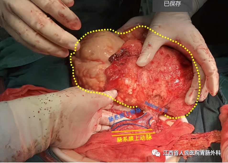 花季少女切除脏器,花季少女肚子肿瘤