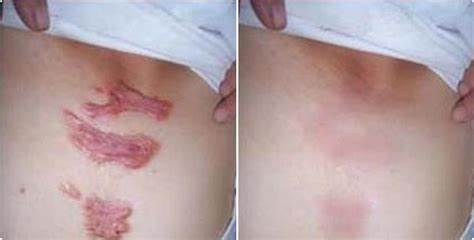 像个“小肉球”似的增生疤痕，是不是无药可救了？医生这样说：