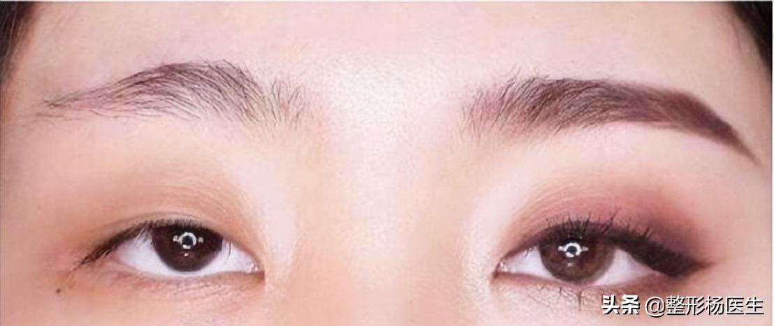 双眼皮手术超详细讲解！了解双眼皮看这一篇就够了