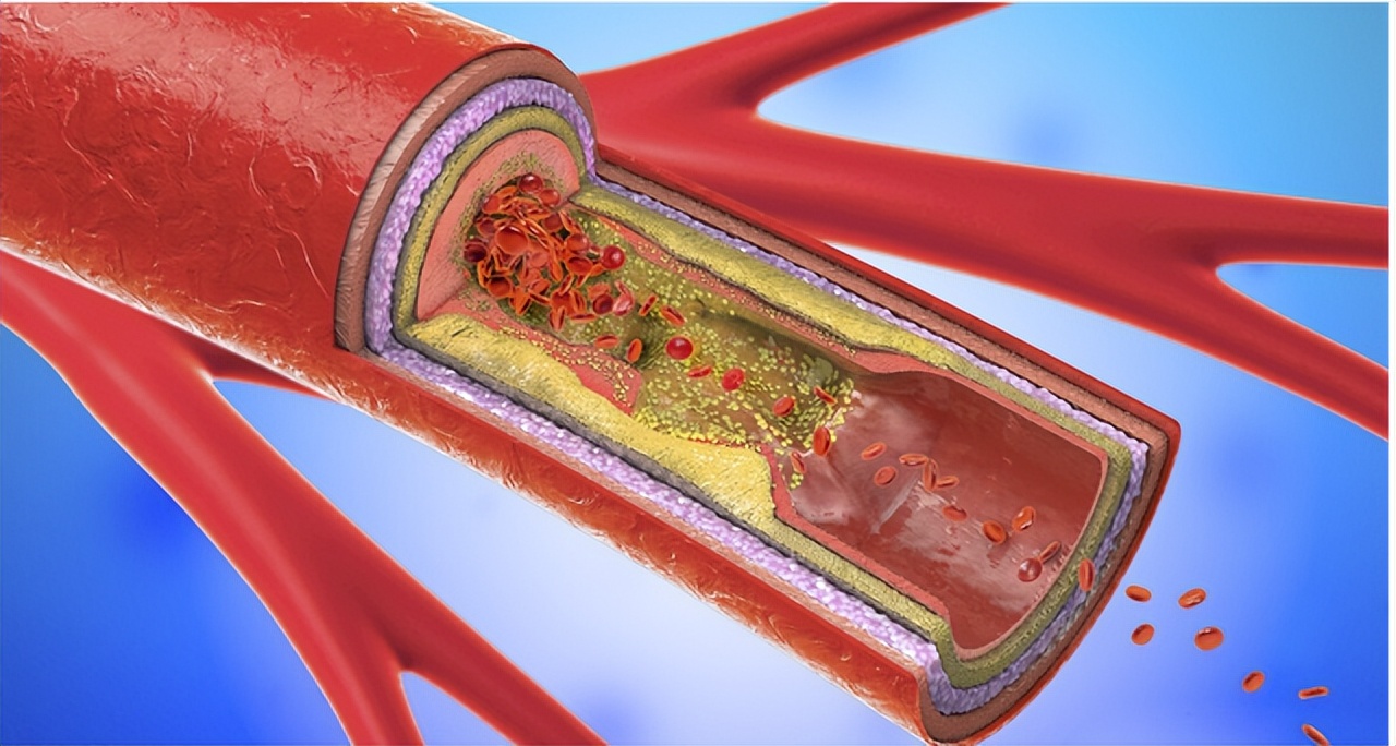 脑梗病人服用尼麦角林起什么作用,血塞通和尼麦角林哪个治脑梗塞好