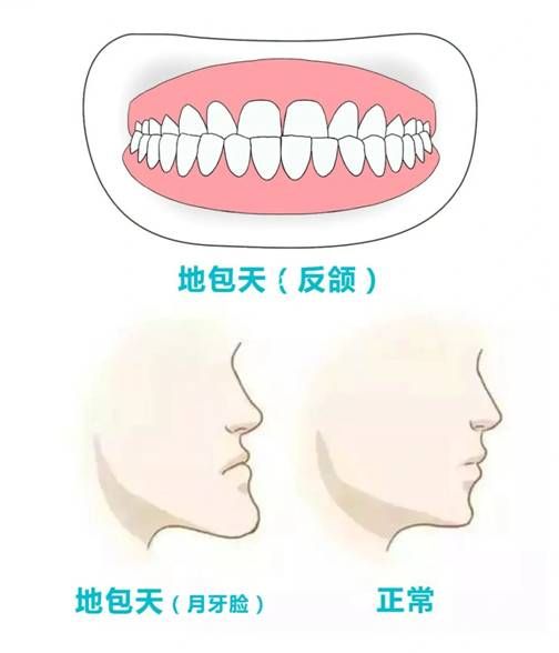 地包天矫正越早越好吗,地包天矫正到什么程度需要拔牙