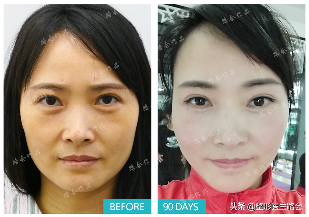 北京眼袋泪沟手术,老人泪沟眼袋