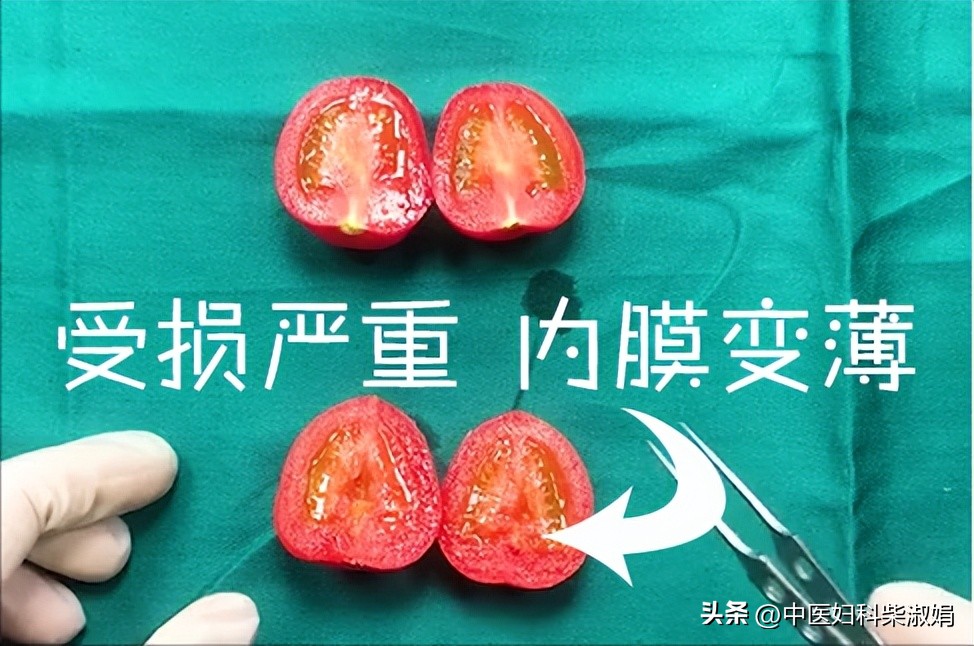 一组图，揭秘人流后的子宫状态，结果太直观了