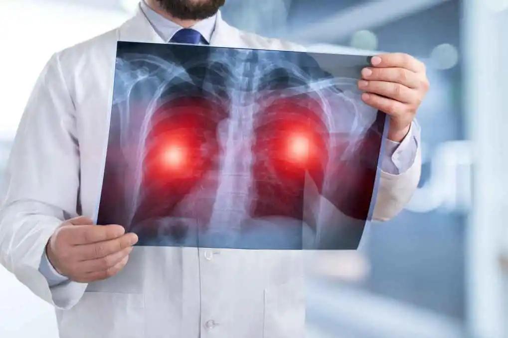 肺癌如此高发，究竟是何原因？