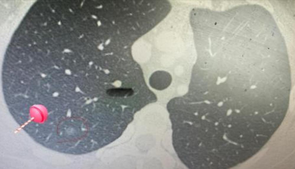 宫颈癌术后肺磨玻璃结节,宫颈癌或者癌前病变