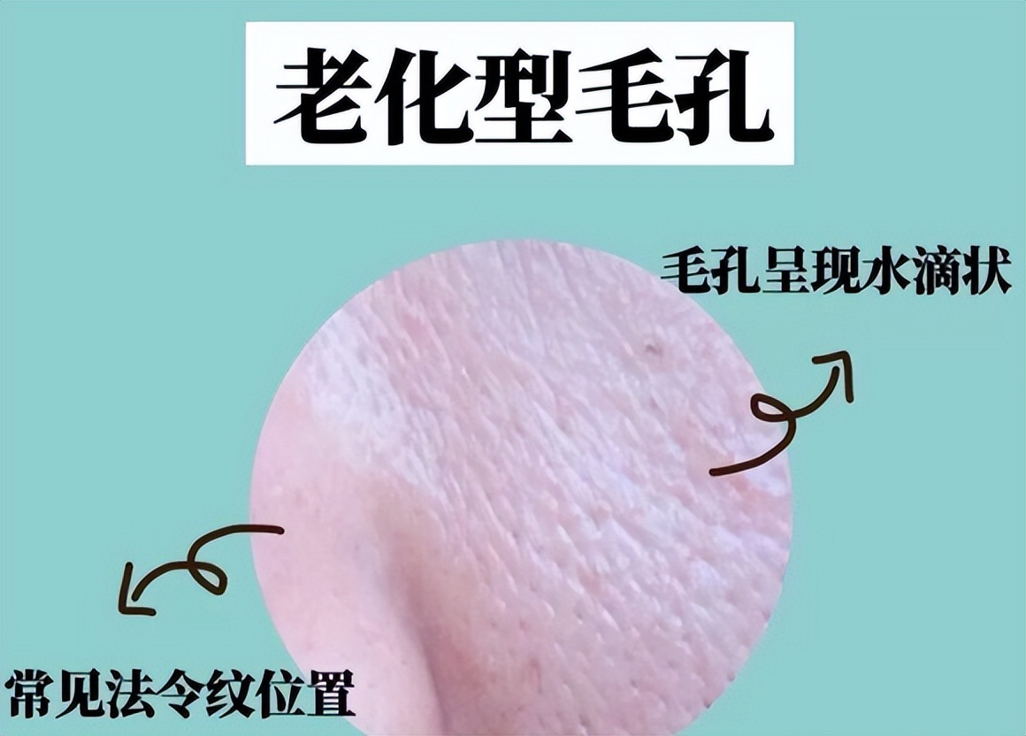 4种类型的毛孔粗大该怎么解决,怎样判断毛孔粗大的类型