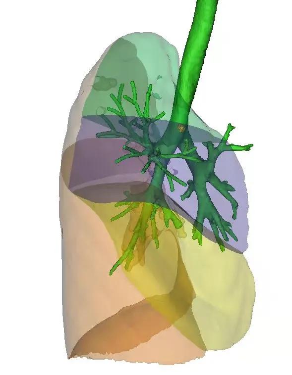 新桥磨玻璃结节,磨玻璃结节微创单孔