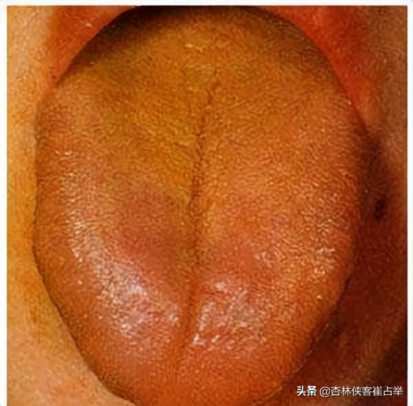 心热烦躁吃哪种地黄丸,六味地黄适合用于什么舌象