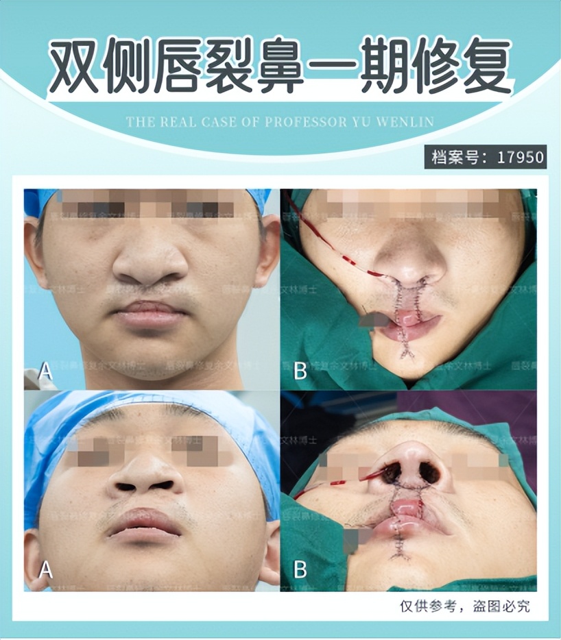 唇裂的分级,唇裂看病经验分享