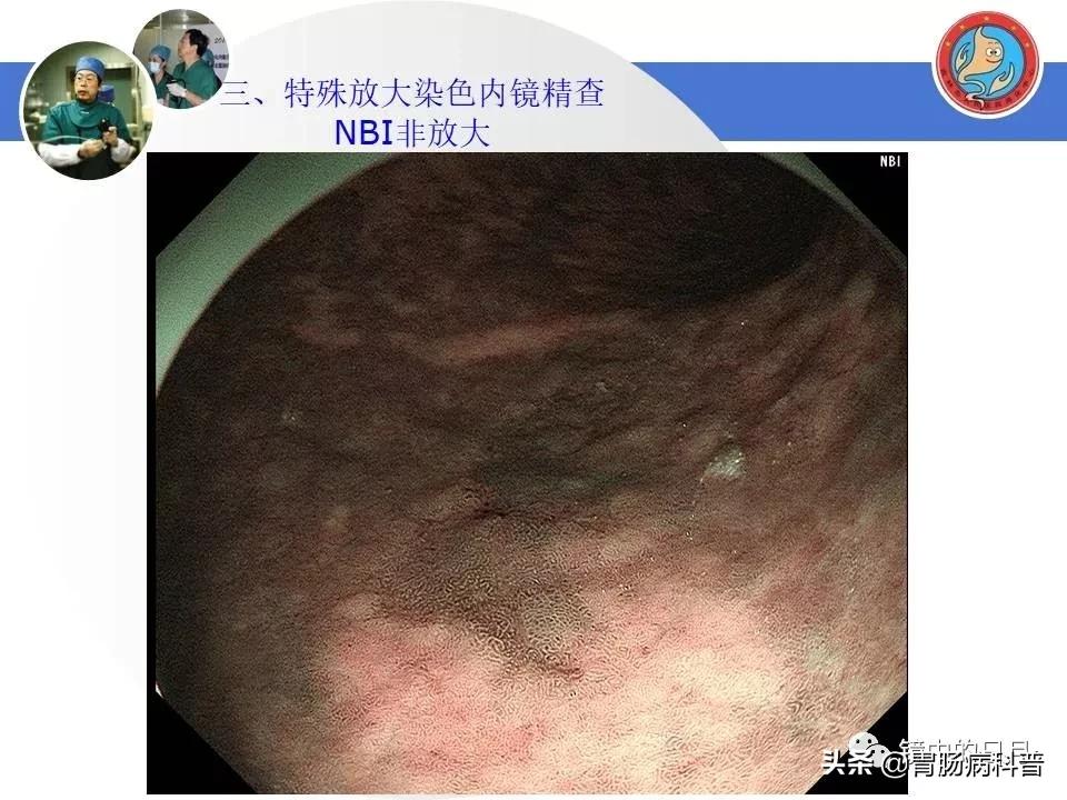 胃癌可以做内镜手术吗,早期胃癌内镜手术后追加外科手术