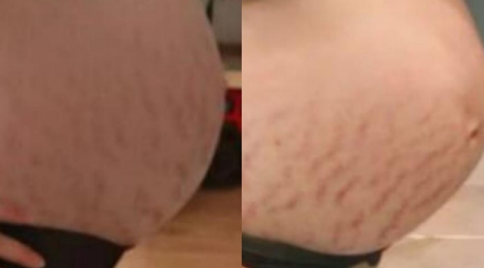 产后如何淡化妊娠纹一个妙招,产后淡化妊娠纹最有效的方法