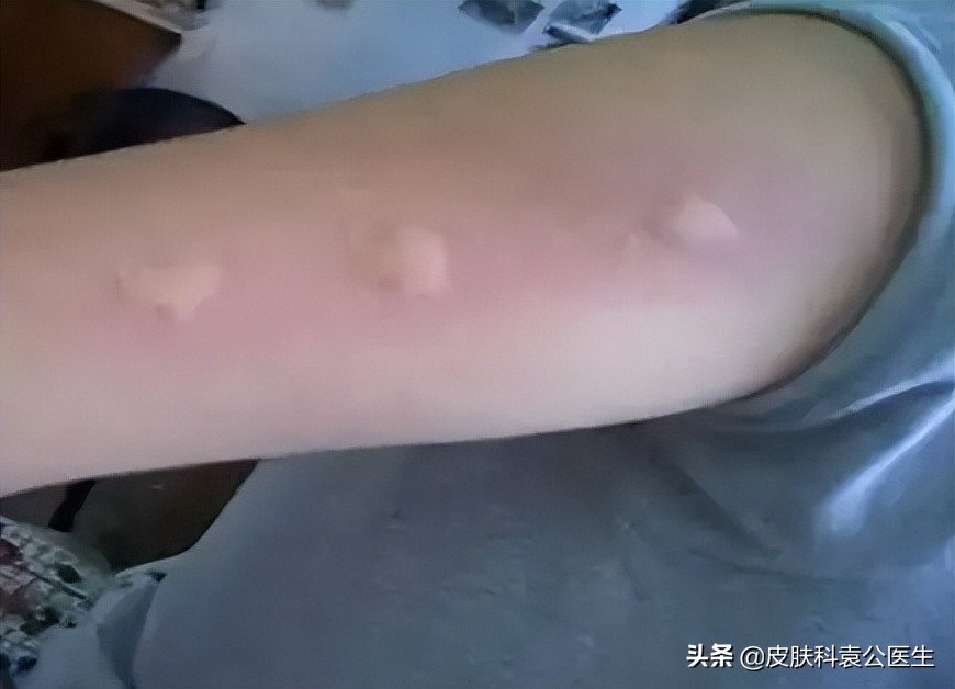 蚊虫叮咬引起的皮炎一年了没好,夏季有哪些虫叮咬会红肿