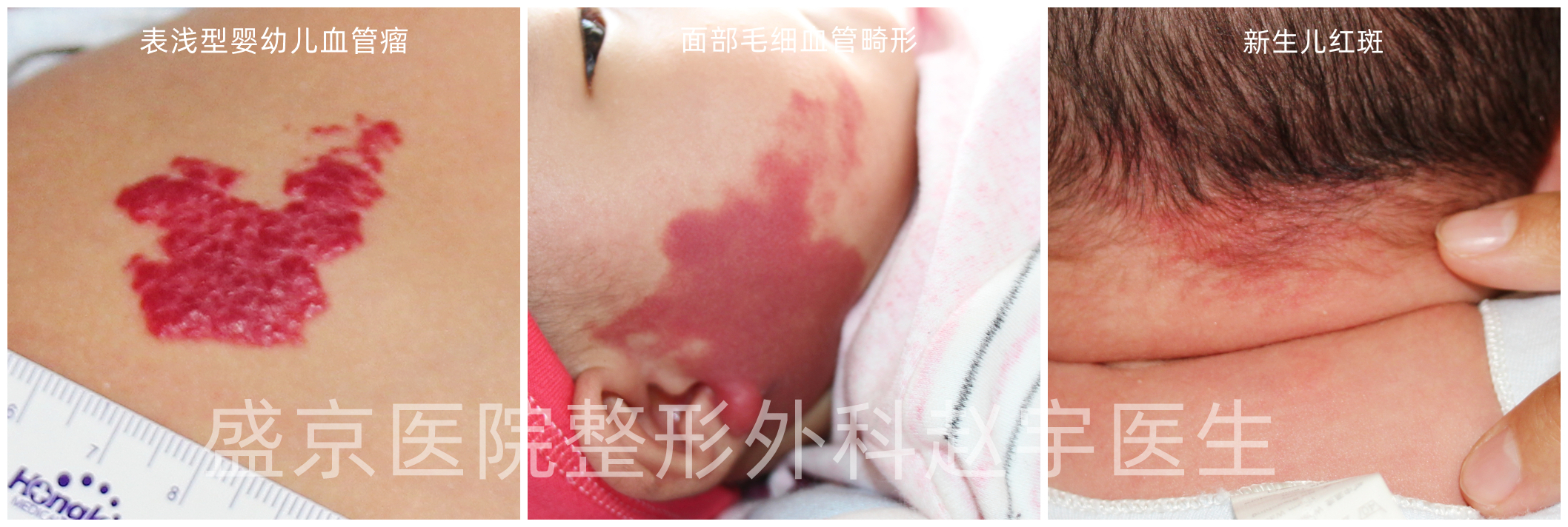 婴儿红胎记,婴儿红胎记图片大全