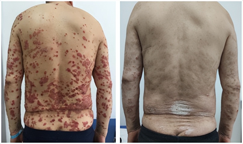 有不良反应是否应该停止用药,治疗期间出现药物不良反应怎么办