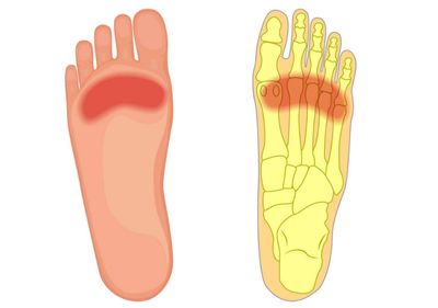 足底筋膜炎脚抬高非常疼,足底筋膜炎引起的脚疼怎么办