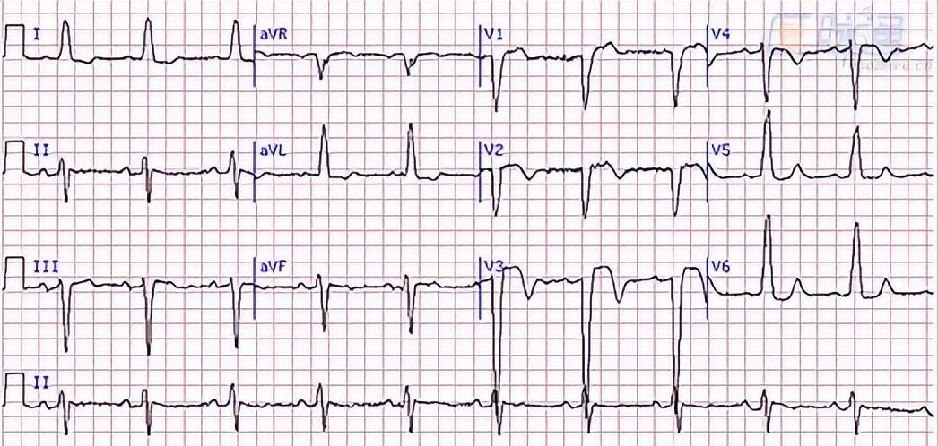 焦虑症惊恐发作时怎么自救,惊恐发作的治疗和自救有哪些方法
