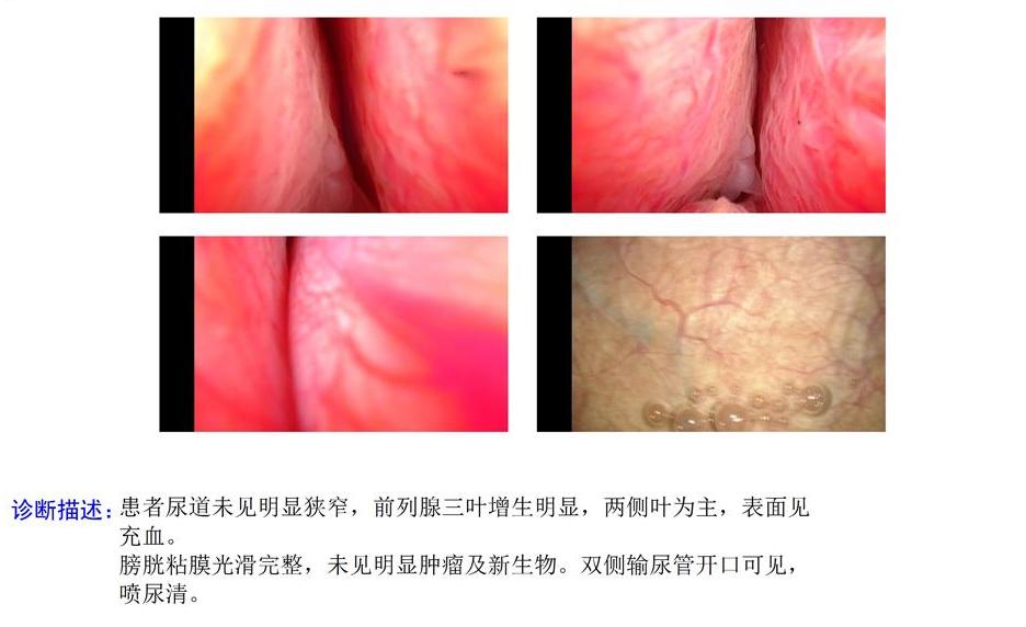 70岁前列腺增生电切术,70岁老大爷做前列腺手术