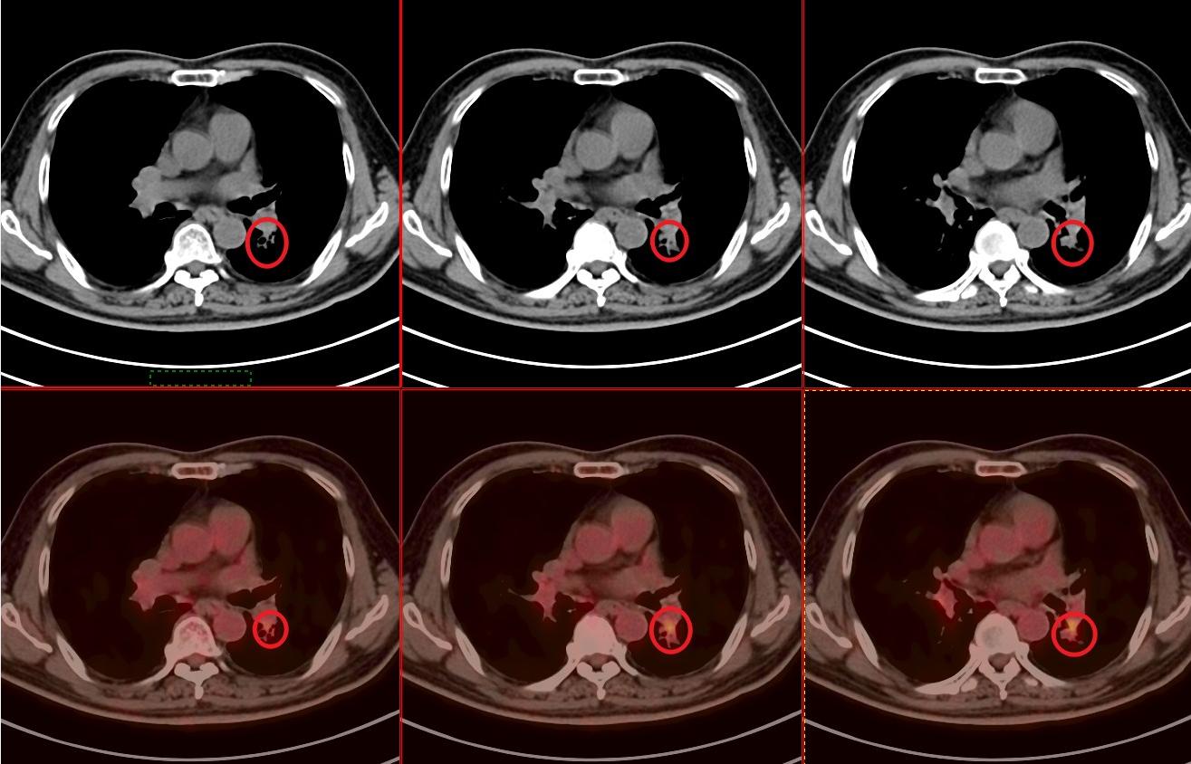 PET/CT病例（6）：4.0cm肺癌治疗后缩小到1cm，来看看治疗方案