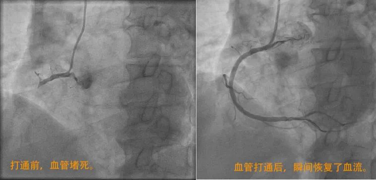 男子发生第三次心梗,男子一年三次患心梗