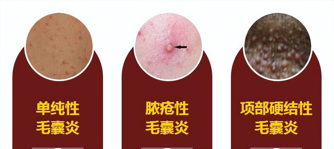 头皮上经常长疙瘩和脓包是怎么了,头皮上有脓疙瘩是怎么回事