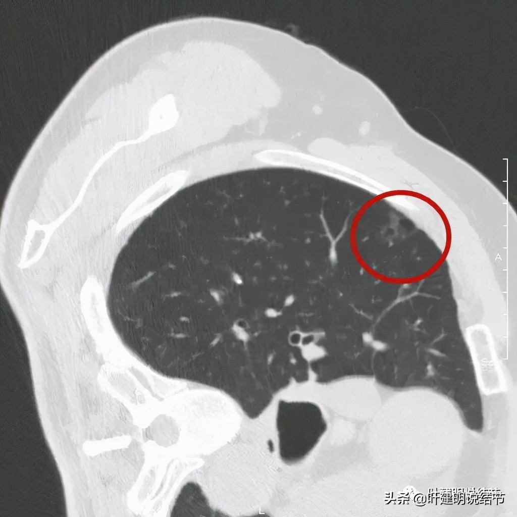 肺多发结节切除一个剩下的怎么办,无限纠结的肺小结节