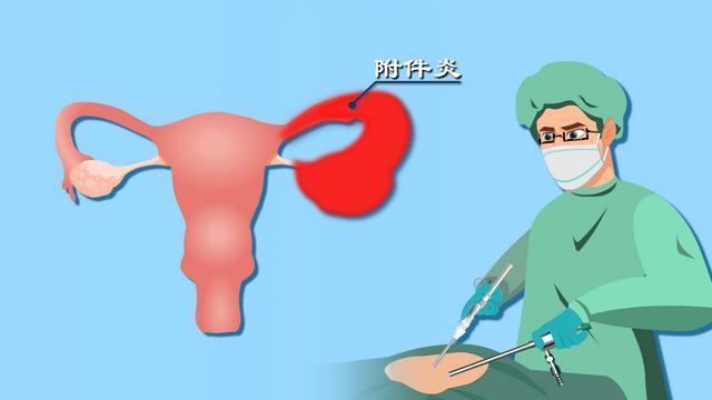 女性附件炎会不会引起小腹不适,女人左侧小腹疼附件炎怎么治
