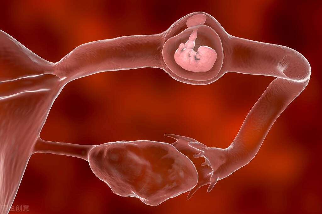 宫外孕出现褐色分泌物危险吗,宫外孕腹腔镜手术危险大吗