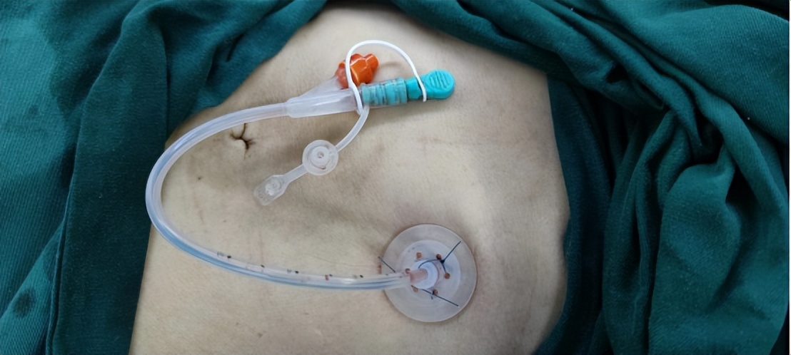 经皮内镜下胃造瘘术福建,河南省渐冻症胃造瘘手术的医院