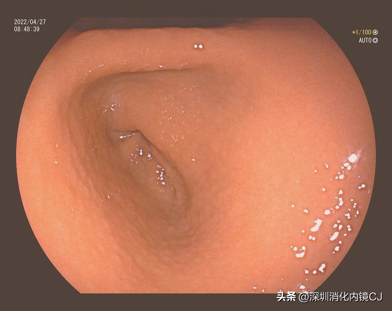 幽门螺旋杆菌感染胃粘膜表现,没有幽门杆菌但是胃窦鸡皮样改变