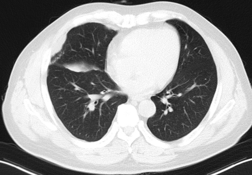 海南首例恶性胸膜间皮瘤,胸膜间皮瘤生存5年算治愈吗