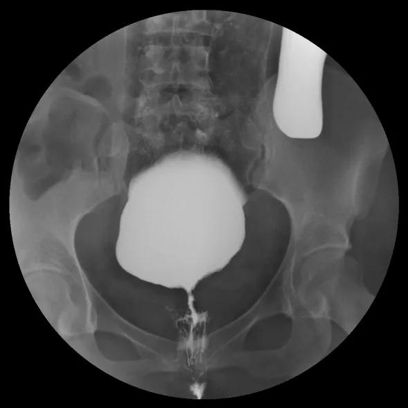 便便从阴道里出来？20多岁的她面临的问题不止如此……