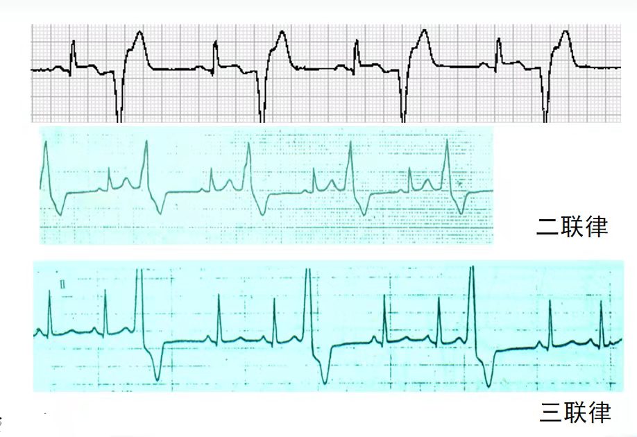 心律失常四型,心律失常四肢乏力胸口难受