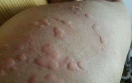 全身起麻疹很痒怎么办,皮肤荨麻疹瘙痒最简单自愈方法