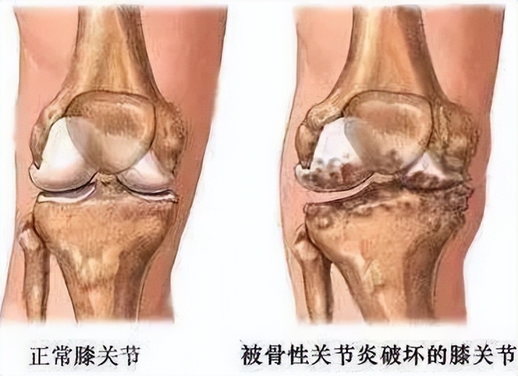 膝关节疼痛的预防和康复方法,膝关节换人工关节后果