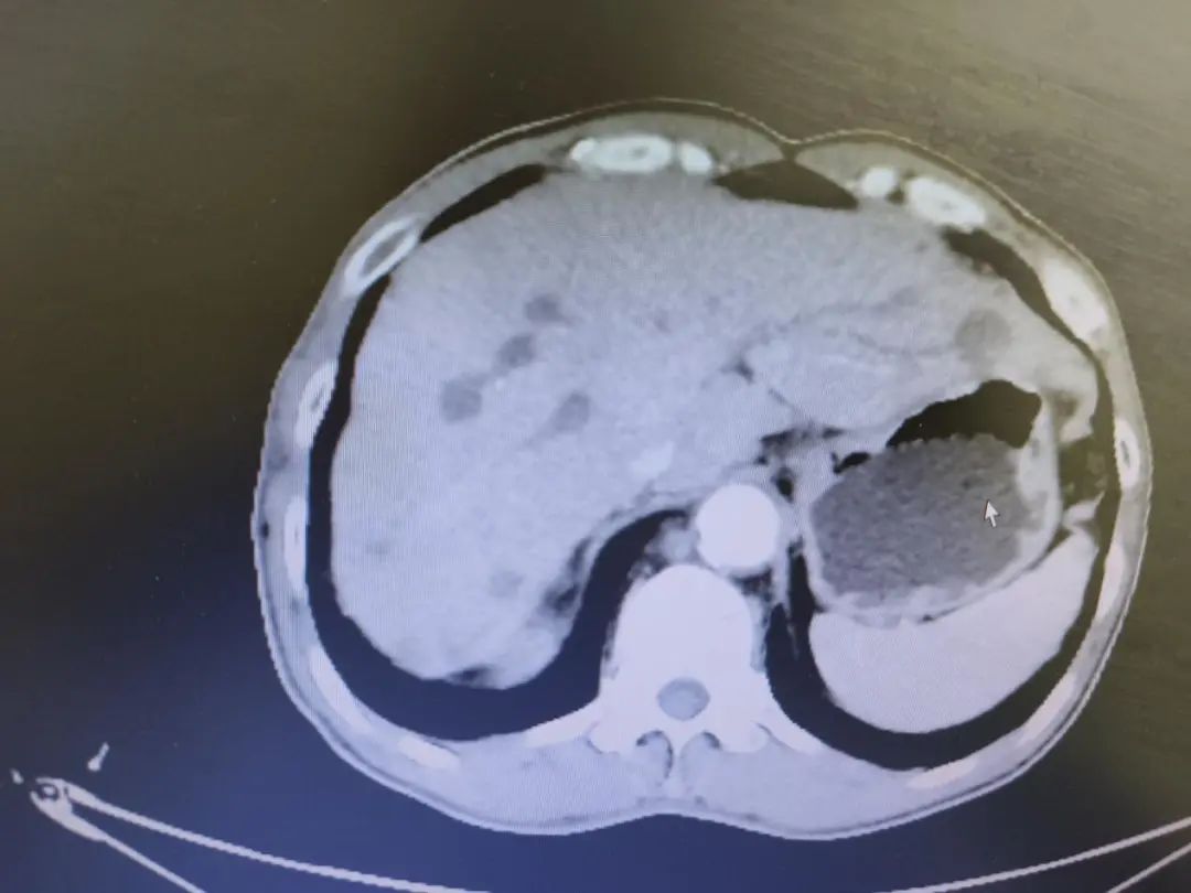 胃癌晚期化疗的全过程视频,化疗过程视频完整版胃癌