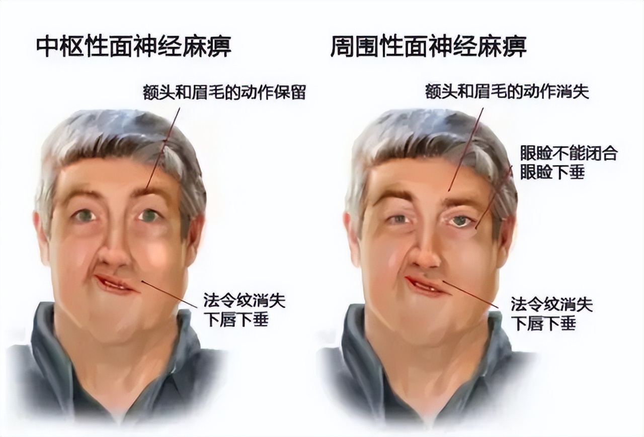 女子胃痛后面瘫，疑似神经发炎，做了高压氧，直到瘫痪才找到病因