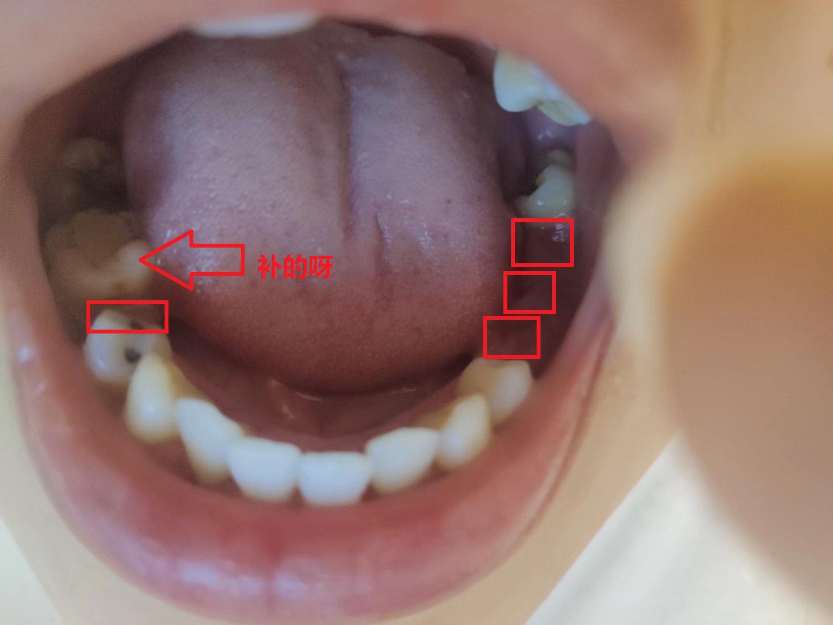 23岁还没有牙齿,30岁没牙
