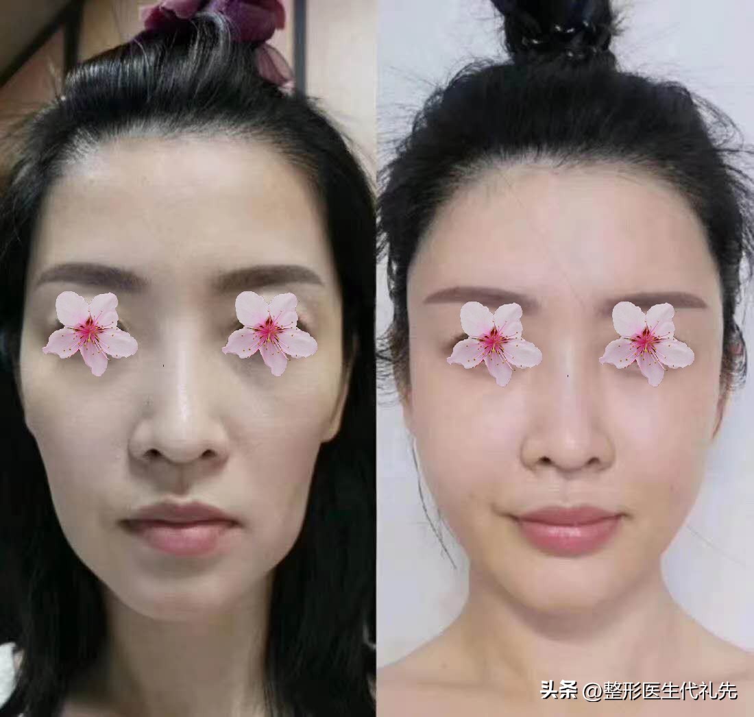 面颊凹陷填充会改善法令纹吗,面颊凹陷下垂如何填充