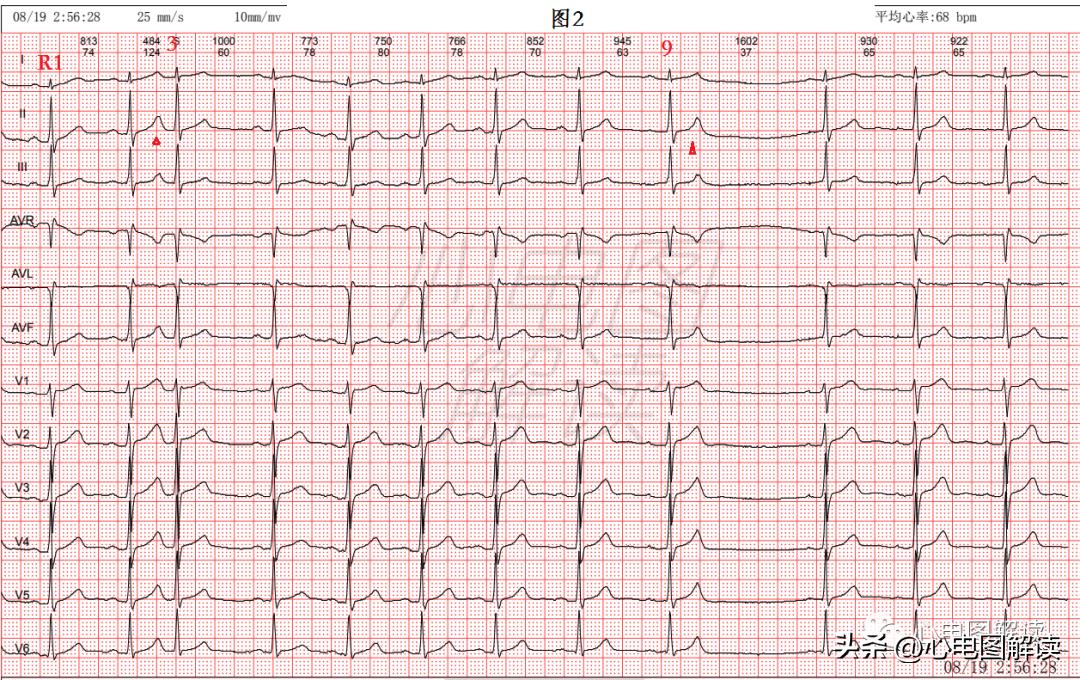 房早室早区别,房早室早房颤