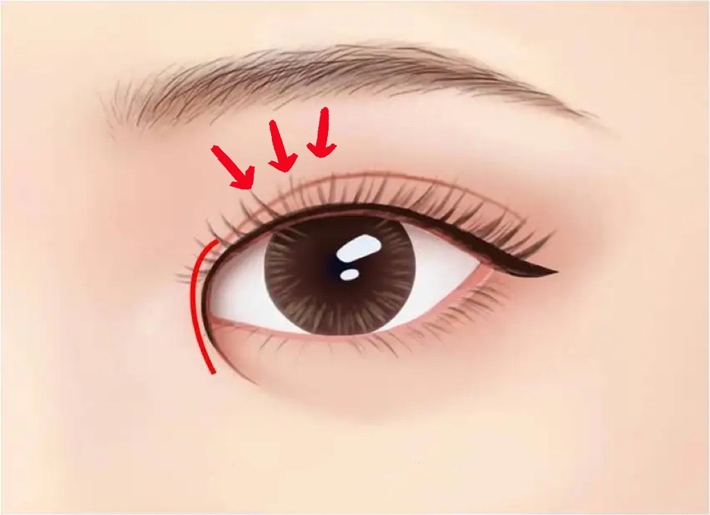 整形科普知识修复双眼皮,双眼皮整形有哪些常见方法