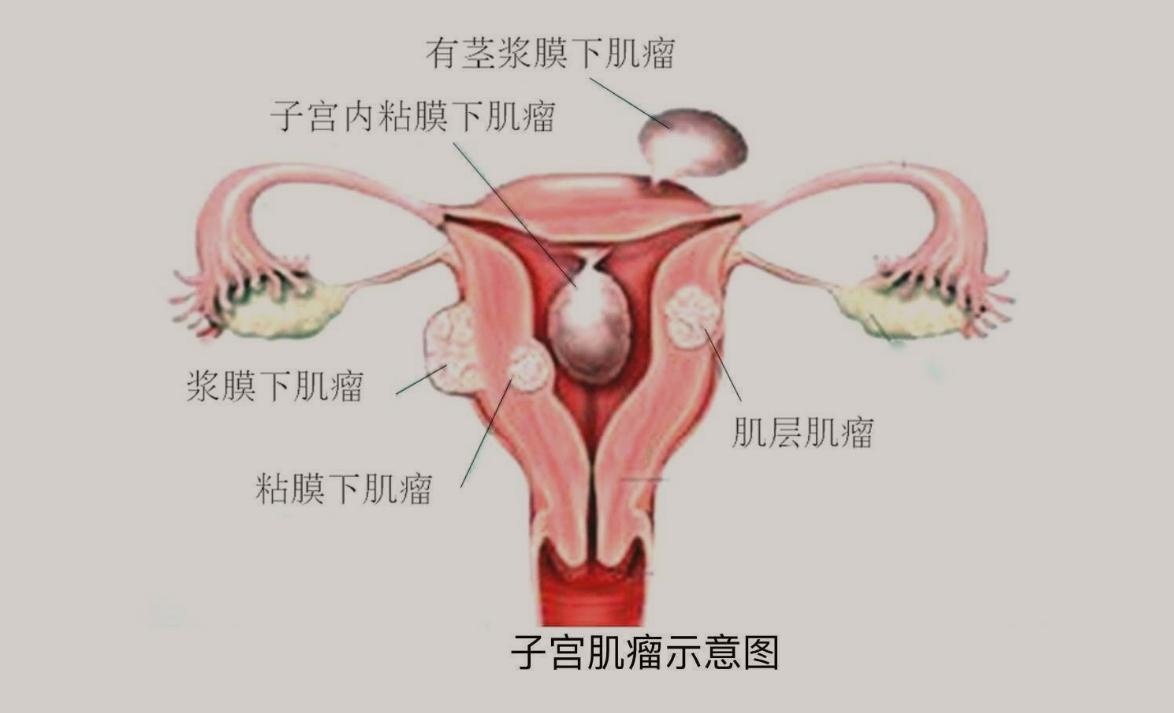 医生不告诉你妇科秘密,医院检查发现没有子宫正确吗